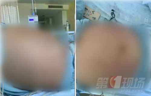 13岁女孩体重超220斤确诊多囊 13岁女孩体重超220斤确诊多囊